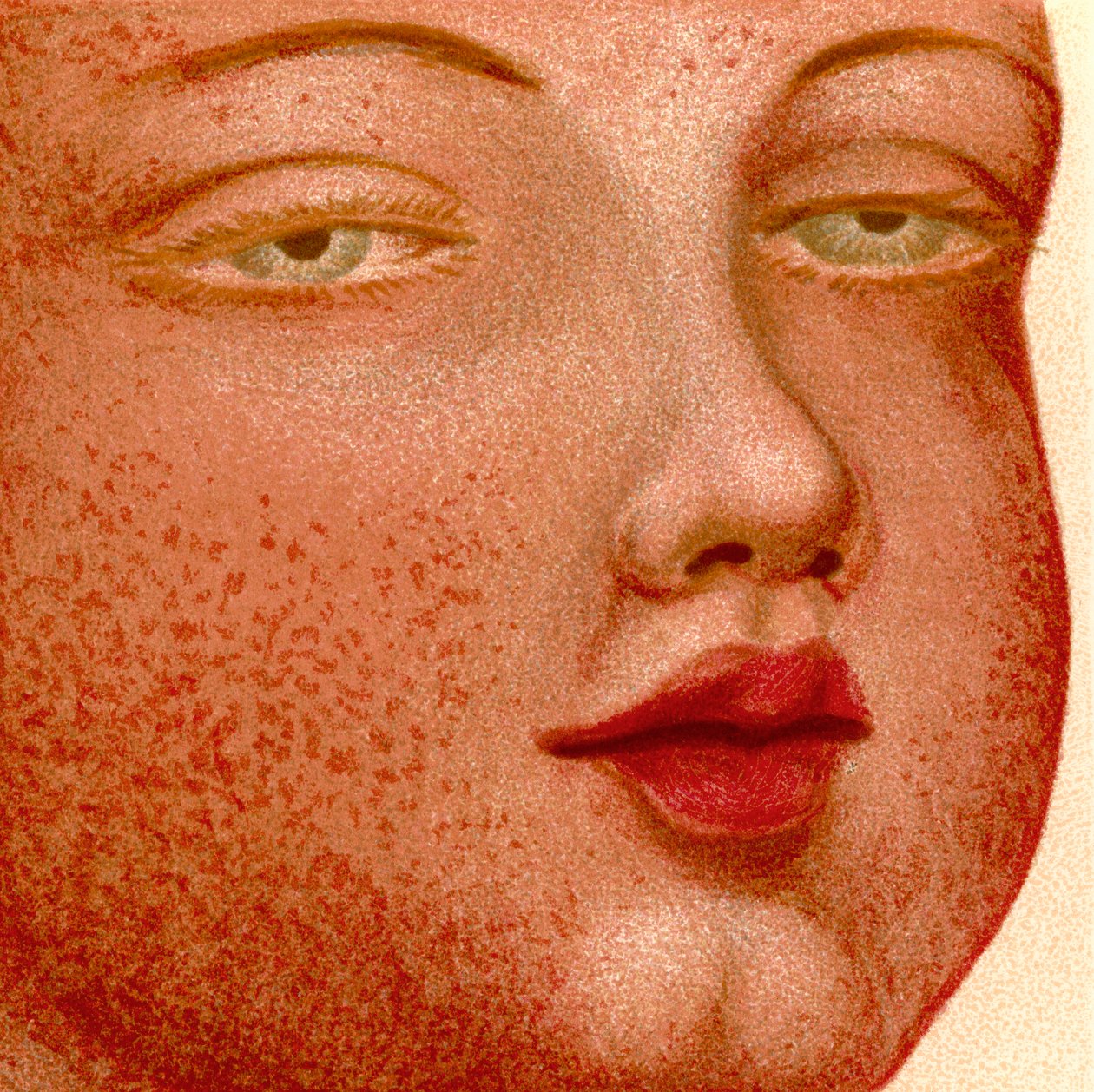 Eruptivfeber: Scarlatina eller Scharlakansfeber av Unknown artist
