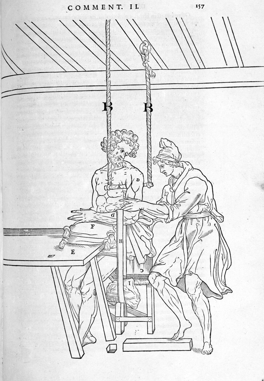 Minskning av frakturer. Plåt illustrerad av "Dissektionen av människokroppen i tre delar..." av Carlo Stefano Riverio, Paris 1545 av Unknown artist