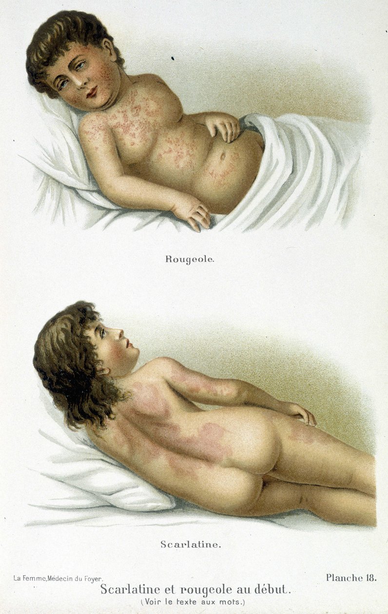 Scharlakansfeber och mässling - 1800-talet av Unknown artist