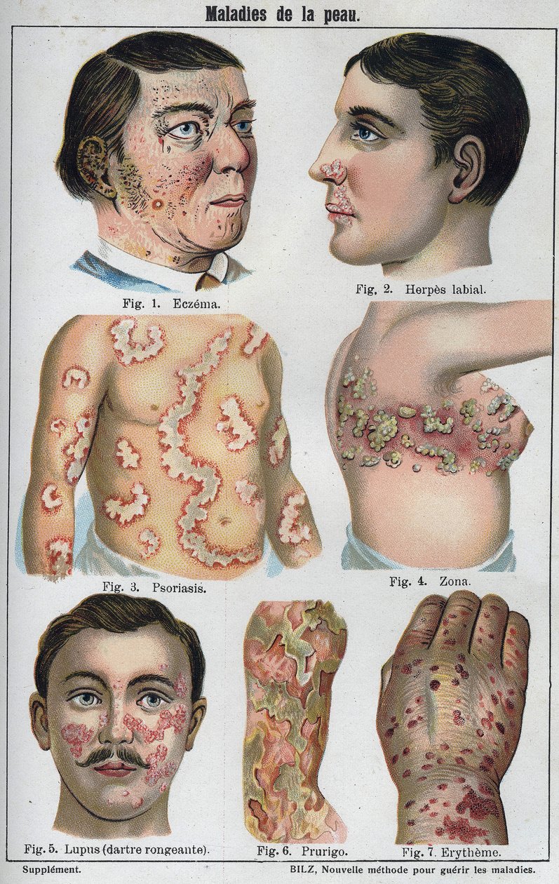 Hudsjukdomar: Eksem, labial herpes, psoriasis, bältros, lapus (ruttnande darter), prurigo, erytem." Den nya naturliga medicinen”” av F.E. Bilz. av Unknown artist