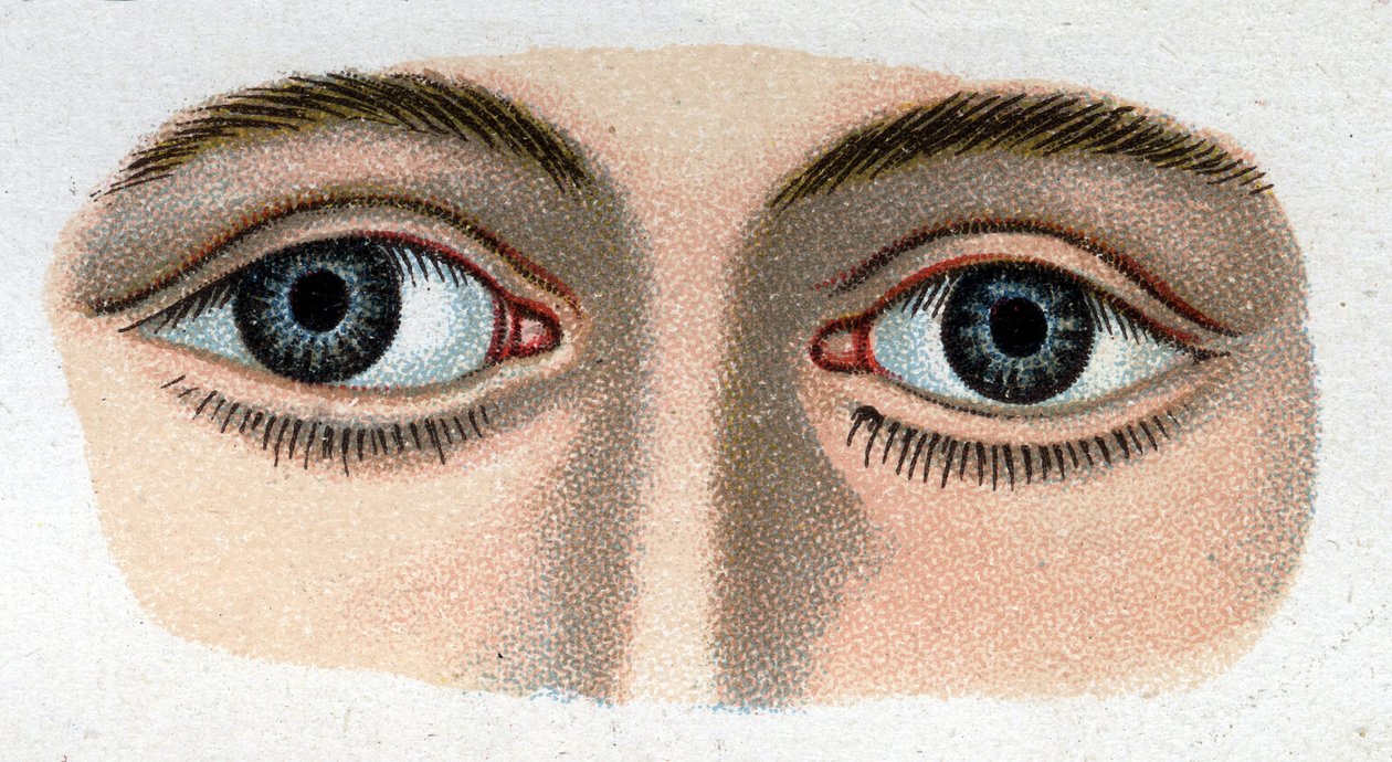 Strabismus divergerande. "Den nya naturliga medicinen" av F.E. Bilz. av Unknown artist