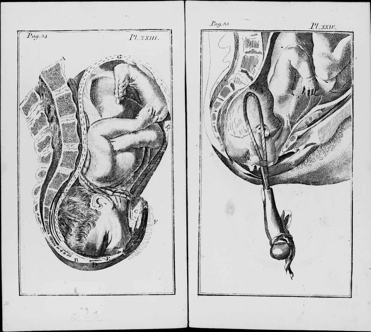 Födelse av ett barn med användning av pincett Platta från "An abridgement of the practice of midwifery"" av William Smellie (1697-1763) av Unknown artist