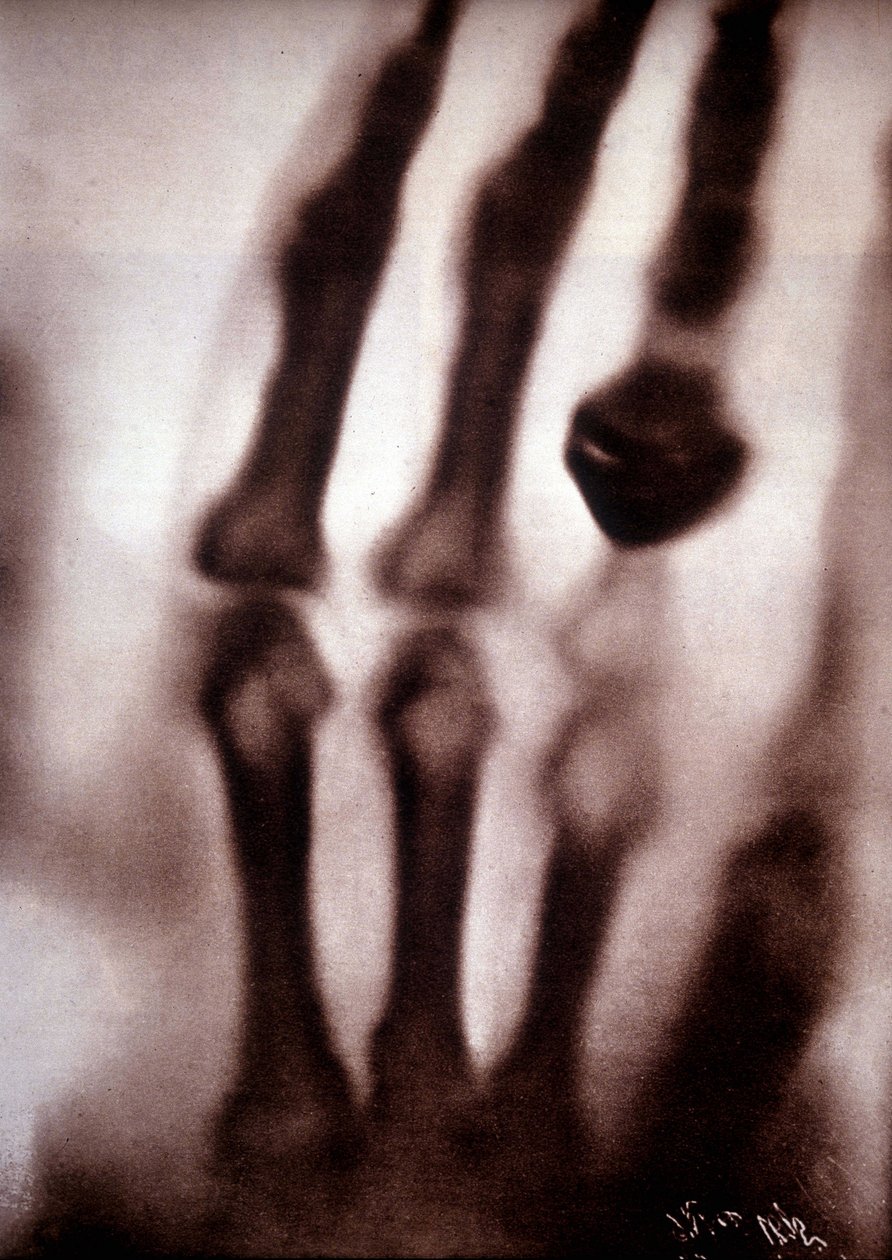 Röntgenstrålar (Rontgen) eller röntgenstrålar Första fotografiet: Röntgens hustrus hand. 1895-12-22. av Unknown artist
