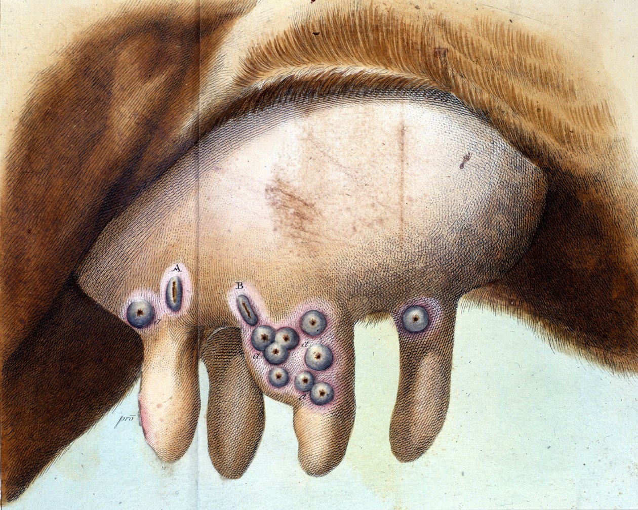 Kobröstet användes för att inokulera smittkoppsvaccinet av Luigi Sacco (1769-1836) i januari 1801. Medicinsk platta från "" Vaccination Treat" av Luigi Sacco, Milano av Unknown artist