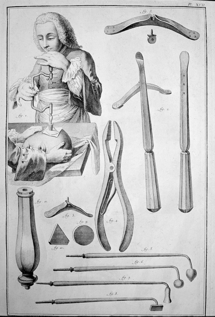 Trepanering av skallen, olika instrument (gravyr av Unknown artist