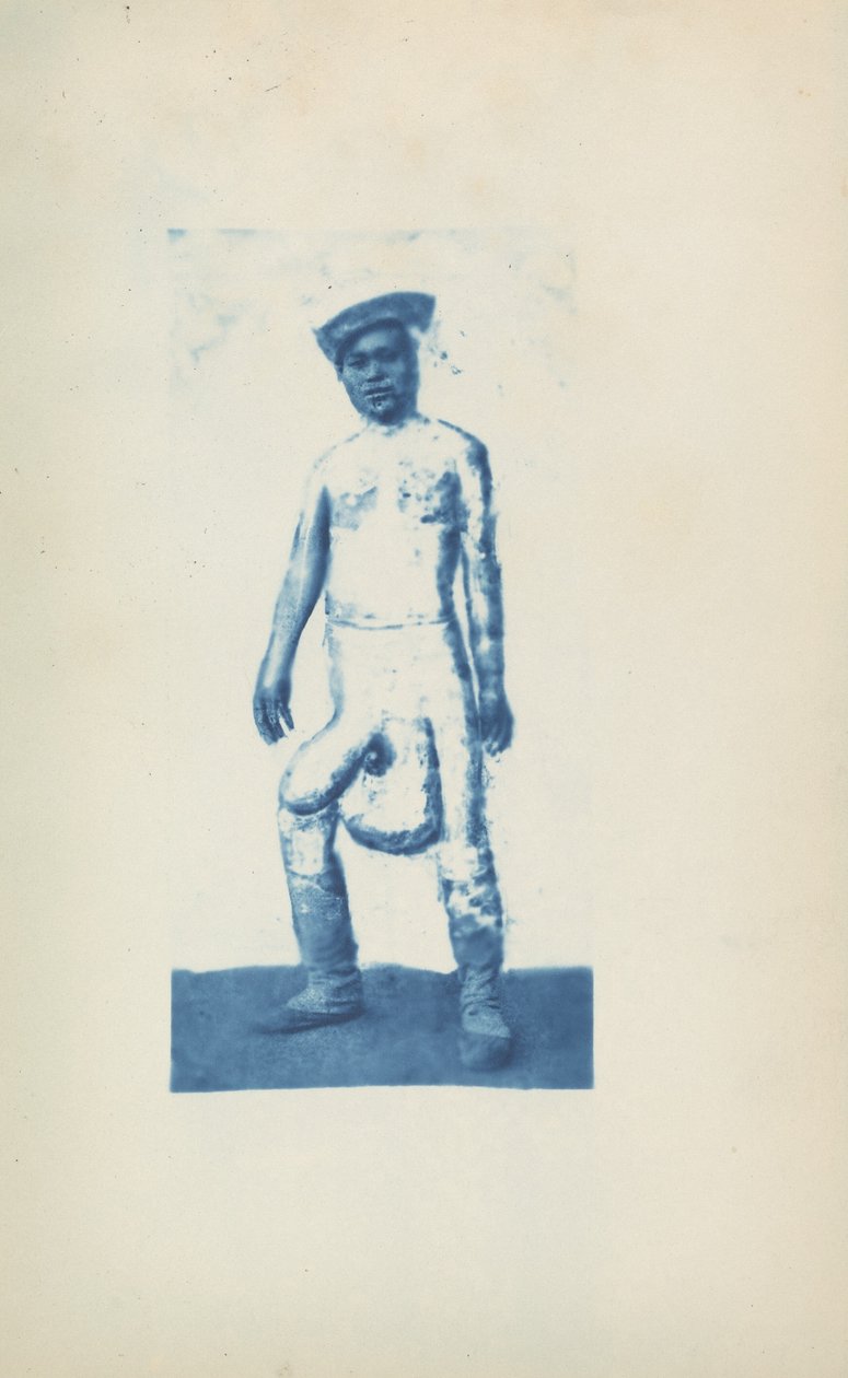 Elefantiasis,ca. 1870-talet (foto) av Unknown photographer