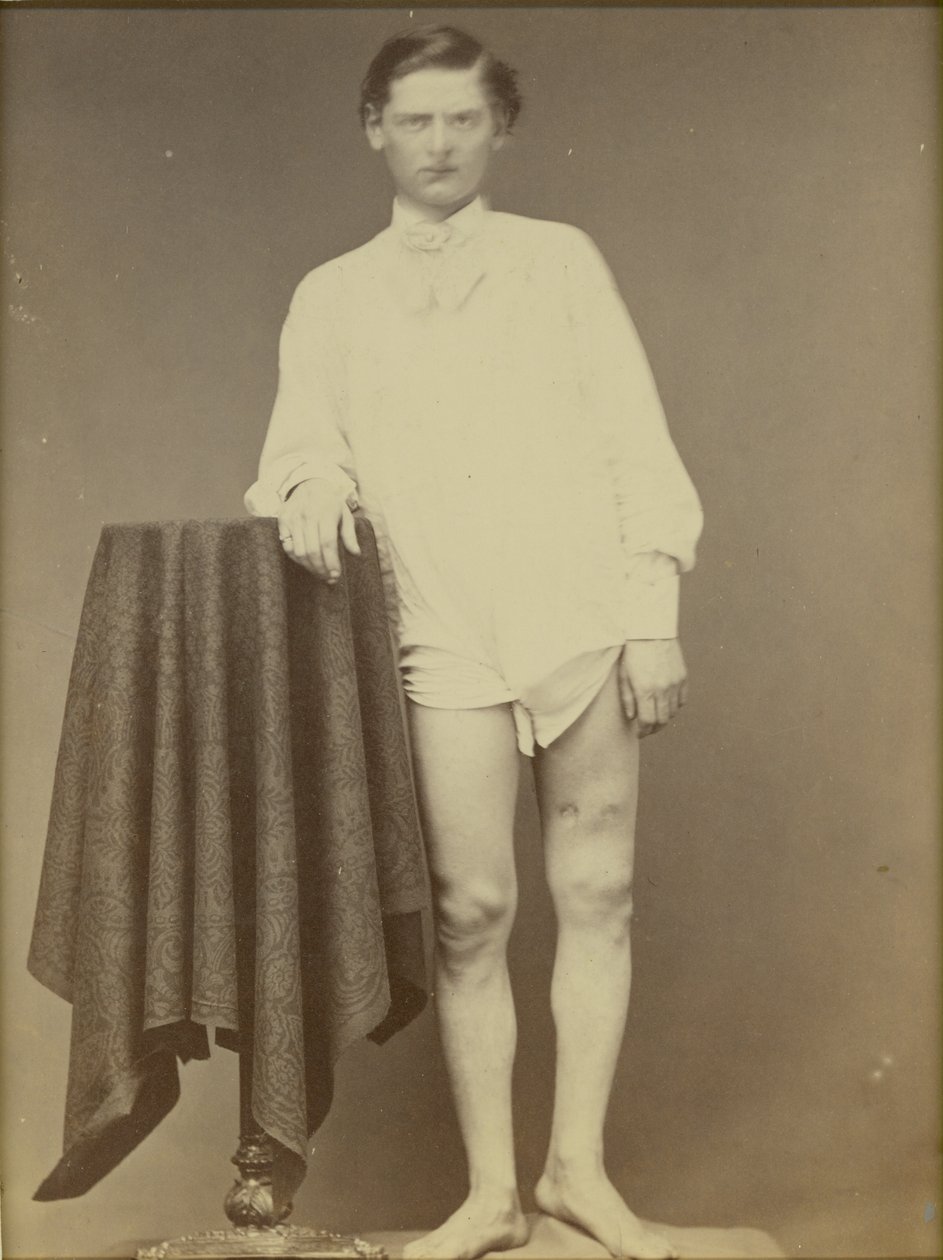 Skadad inbördeskrigssoldat (privat Charles Westerfield, Army Medical Museum-exemplar nr. 4278), april 1865, 1865 (albumintryck) av William Abraham Bell