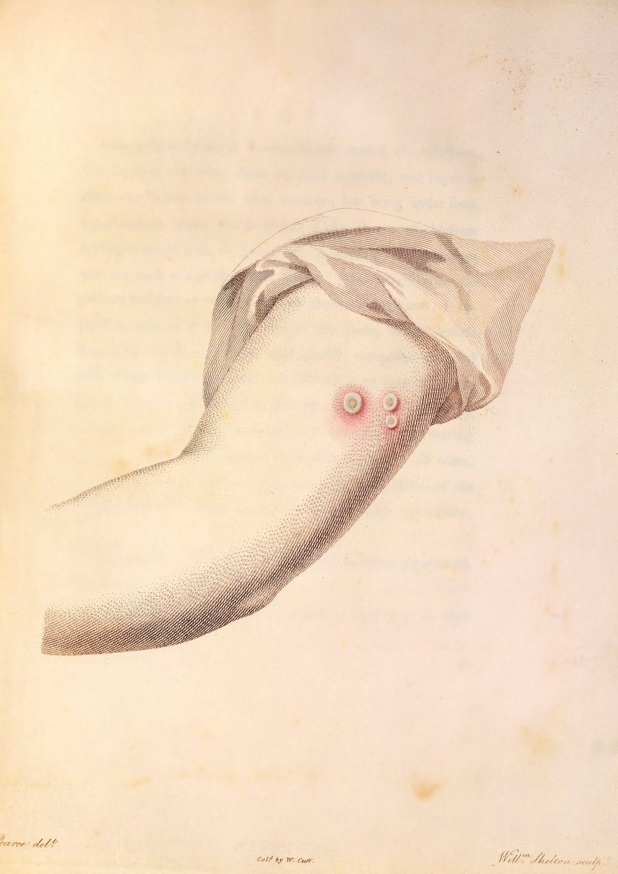 Arm of William Pead används för smittkoppsvaccin, från 