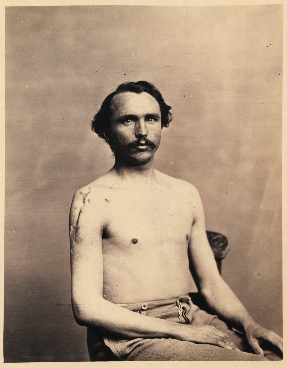 Menige Adolph Zirsse, lyckad mellanliggande excision av huvudet och två och en halv tum av skaftet på höger humerus, från den kirurgiska avdelningens fotografiska katalog av William Bell
