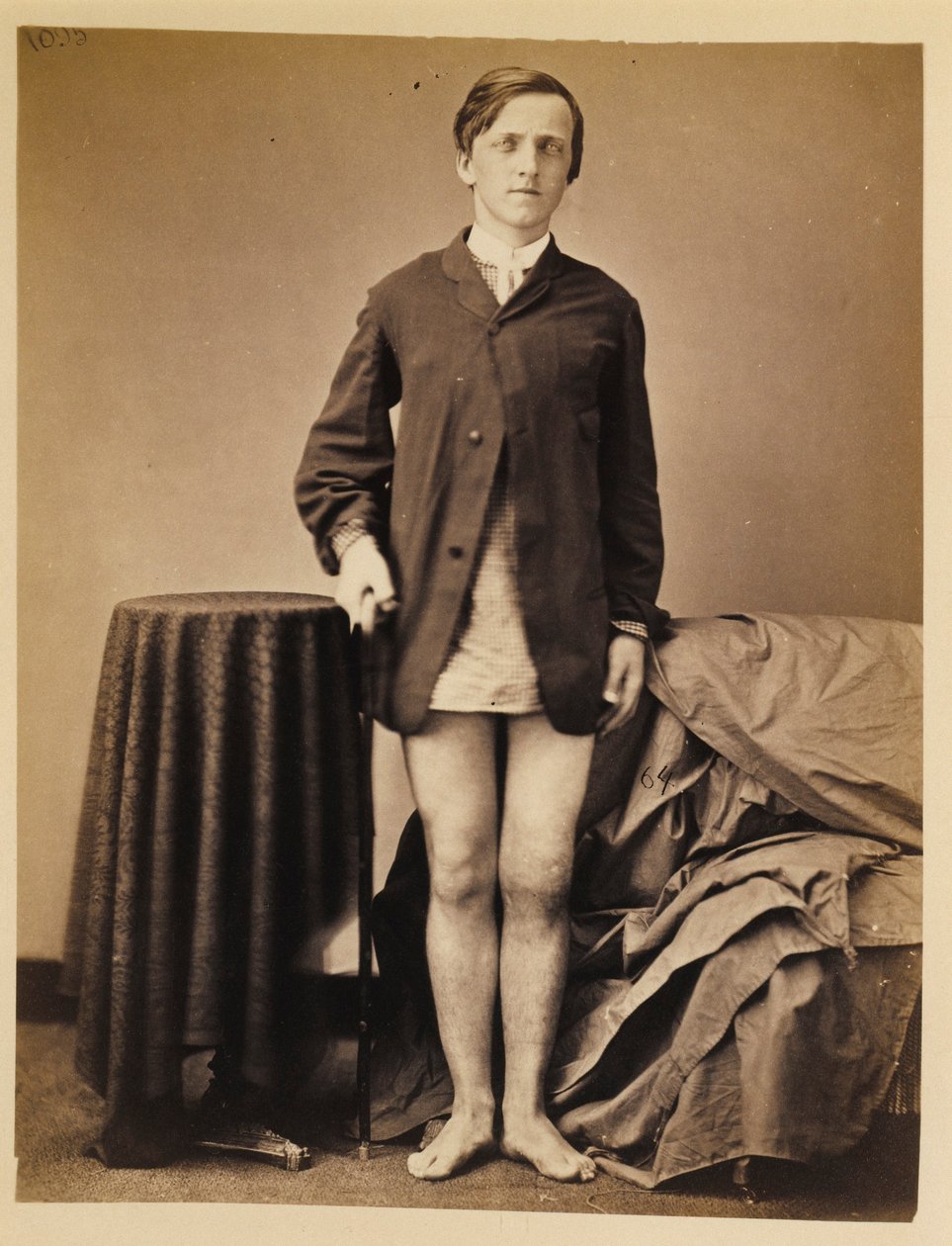 Menige G. W. Warrington, tillfrisknande utan amputation efter skottfraktur på höger patella, från kirurgiska avdelningens fotokatalog av William Bell