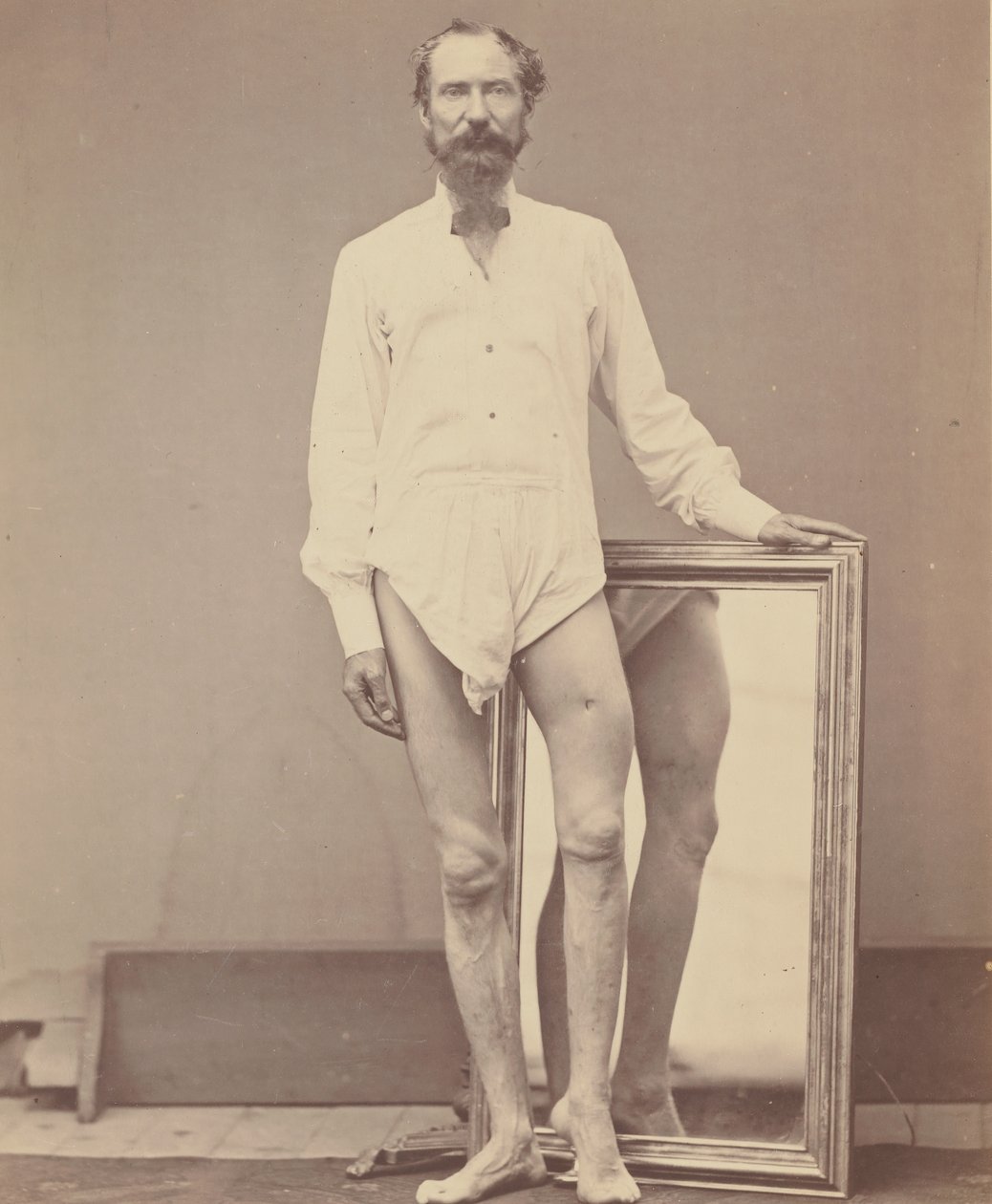 Skottsår av den mellersta tredjedelen av vänster lårben, 1865-67. av William H. Bell
