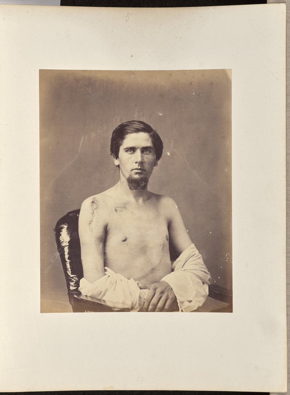 Lyckad excision av huvudet på höger humerus av William H. Bell