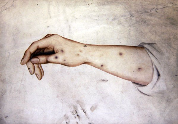 Studie av en underarm med hudtillstånd, ca 1850 (akvarell på papper) av William Lover