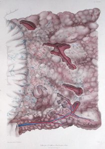 Epiploonens cancer, från 