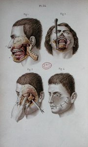 Anatomisk platta i överkäken av C and Huette E. Bernard