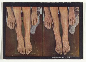 Exfoliativ dermatit av Dr. Selden I. Rainforth
