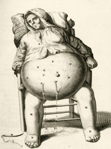 Dränering av vätskor från en abscess av Frederik Dekkers, 1694 av Dutch School