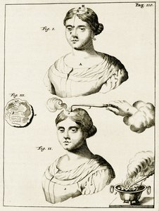 Behandling av en lidande av epilepsi, från Exercises in the Practice of Medicine av Frederik Dekkers, 1694 av Dutch School