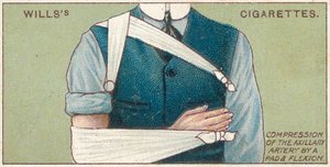 Kompression av axillärartären med en dyna och böjning, nr 41 från First Aid-serien av Wills