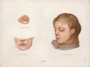 Hudsjukdomar: Herpes (färg litho) av English School