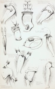 Metoder för att arrestera blödning, c.1890 av English School