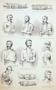 Tillfällig behandling av frakturer, c.1890 av English School