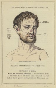 Karakteristiska slag av akut snot (färg litho) av French School