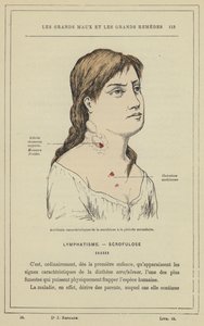 Karakteristiska olyckor av skrofulos i sekundärperioden (färg litho) av French School