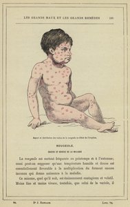 Utseende och fördelning av mässlingfläckar i början av utbrottet (färg litho) av French School