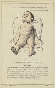 Attityd hos ett litet barn med eklamptiska kramper (färg litho) av French School