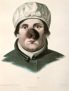 Före en hudtransplantationsoperation, från 