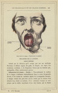 Cancer i tungsår, degeneration av lymfkörteln (färg litho) av French School