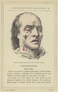 Kläckning av fluglarver i håligheterna och under huden i ansiktet (färg litho) av French School