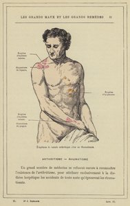 Utbrott av artritisk karaktär hos en reumatisk patient (färg litho) av French School