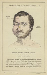 Progressiv erysipelas i ansiktet (färg litho) av French School