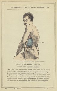 Karakteristisk svullnad av mjälten under malariafeber (färg litho) av French School