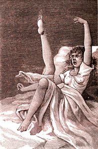 Hysteri, ett extremt mentalt fenomen, psykoser och psykoneuros.1887 (gravyr) av French School