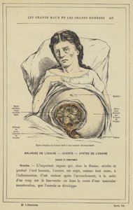 Areolär cysta i höger äggstock i full utveckling (färg litho) av French School