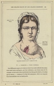 Cloisonne serös cysta i halsen, Lipom i huvudet (färg litho) av French School