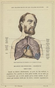 Lesioner karakteristiska för bronkit och bronkial dilatation (färg litho) av French School
