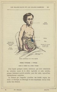 Karakteristiska lesioner av tyfoidfeber (färg litho) av French School