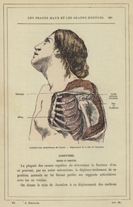 Subcoracoid dislokation av axeln, Förskjutning av huvudet på humerus (färg litho) av French School
