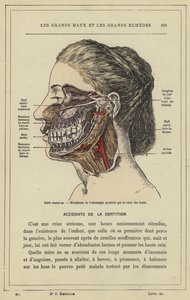 Dentala nerver, Mekanism för odontalgi som orsakas av karies (färg litho) av French School