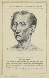 Fysiognomi av patienten under asfyxiperioden av kolera (färg litho) av French School