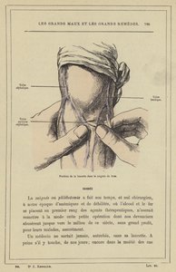 Lansettens position i armblödningen (färg litho) av French School