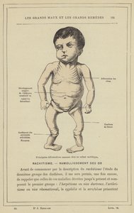 Huvudsakliga bendeformationer hos ett barn med rakitis (färg litho) av French School