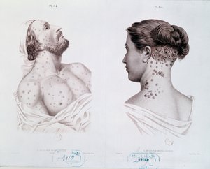 Symtom på syfilis hos män och kvinnor, från en medicinsk bok, c.1850-60 av French School