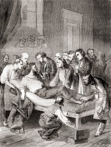 Den första offentliga demonstrationen av användningen av inhalerad eter som ett kirurgiskt bedövningsmedel 1846 av en amerikansk tandläkare, William Thomas Green Morton, från 