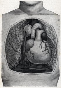 aneurysm ruptur (gravyr) 1888 av French School