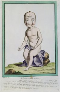 Barn med missbildat huvud, från "Les Ecarts de la Nature", Paris, 1775